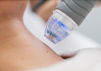 RF Needling – Innovative Hautverjüngung