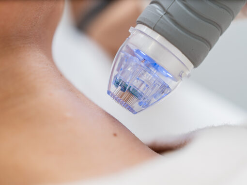 RF Needling – Innovative Hautverjüngung