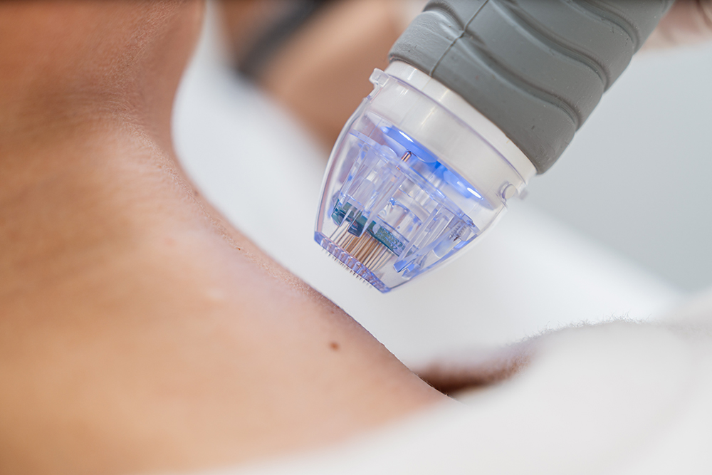 RF Needling – Innovative Hautverjüngung