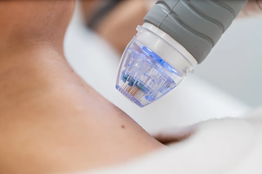 RF Needling – Innovative Hautverjüngung